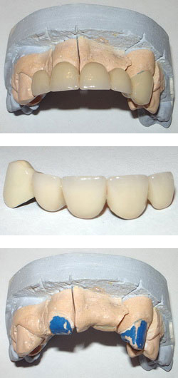 Dentysta Lubań - Mosty porcelanowe